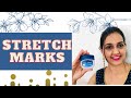 How to reduce stretch marks after pregnancy | use of Vaseline