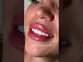 Контурная пластика губ 👄