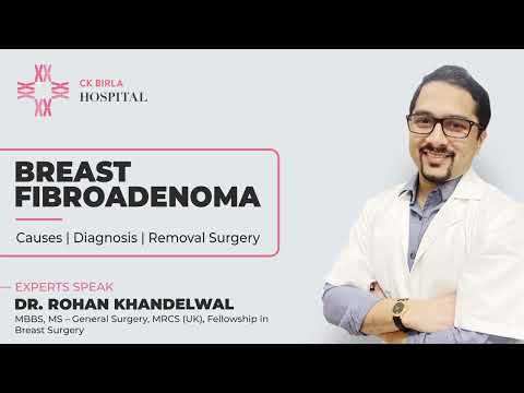 Most common breast lump - Breast Fibroadenoma. Diagnosis & Management by Dr. Rohan Khandelwal