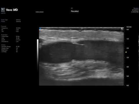 Image of Vevo MD UHF 70 - Adult Vein with Valves