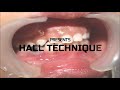 Hall technique i stainless steel crown i pediatric dentistry