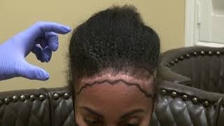 Black Woman Hair transplant on hairline to fix/cover scar from past surgery by Dr. Diep San Jose, Ca