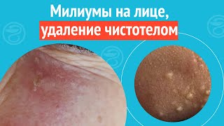 ➡️ Милиумы на лице, удаление чистотелом. Клинический случай №1280