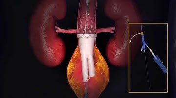 Ovation Prime   TriVascular