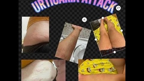 ALLERGY URTICARIA ATTACK