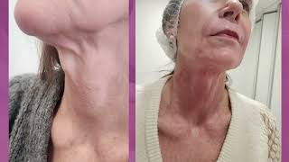 Kijk hoe deze hals zichtbaar lift zonder operatie! | Fusion Plasma resultaat bij Derma Sensation