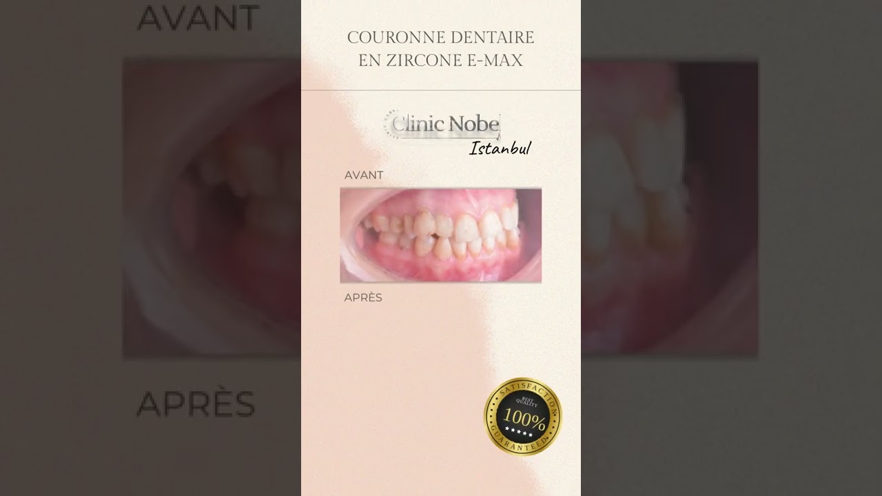 100pc Fausse couronne dentaire Résine Porcelaine Matériau Dents temporaires  Couronne Soins bucco-dentaires réalistes Blanchiment des dents Couronne  molaire antérieure