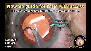 CataractCoach 1196: newbie guide for toric IOL success
