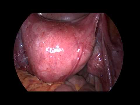 Fibroid, Uterus Retroverted, Uterus Ventrosuspension_009.mpg