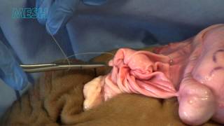 Right Hydrocele Repair