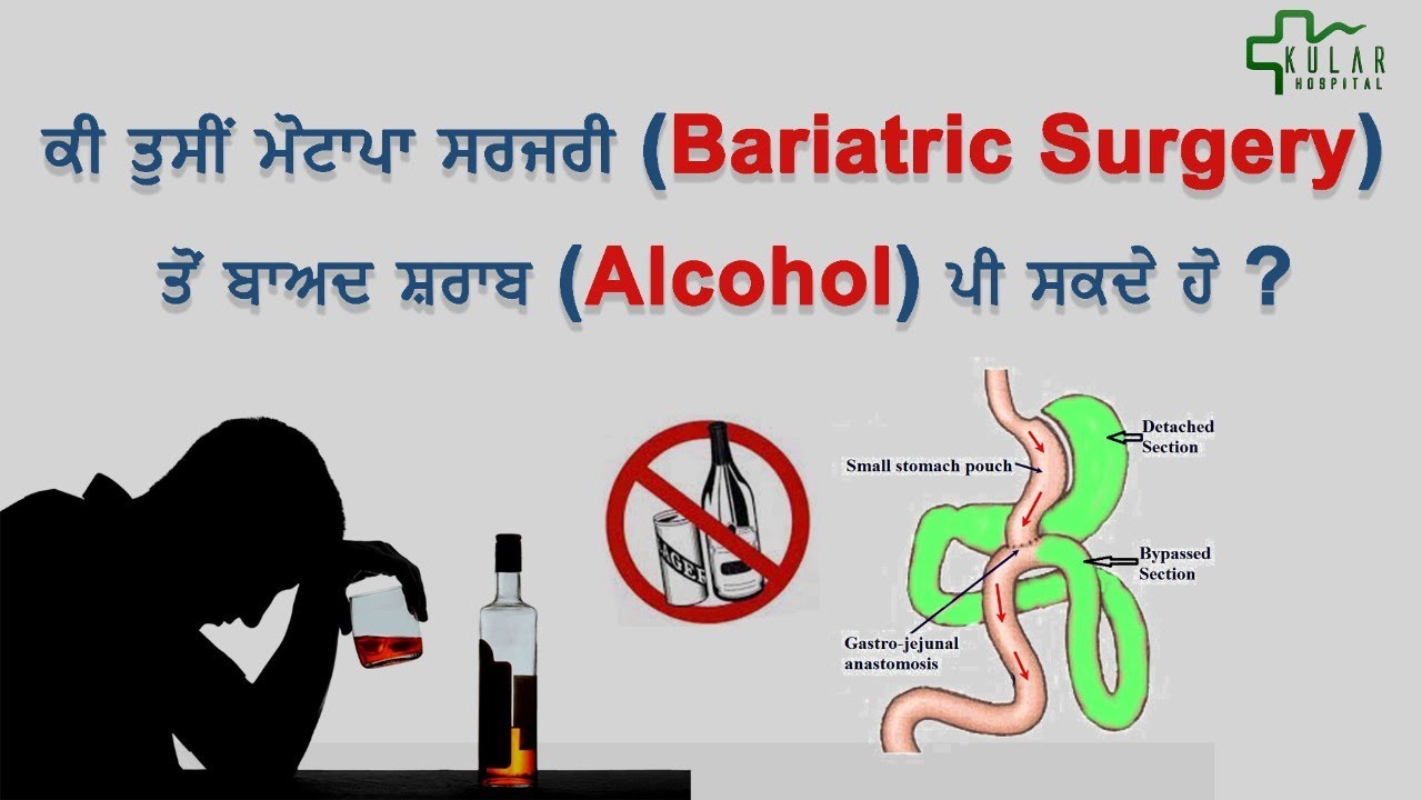 Drinking Alcohol After Weight Loss Surgery (Mini Gastric Bypass Surgery