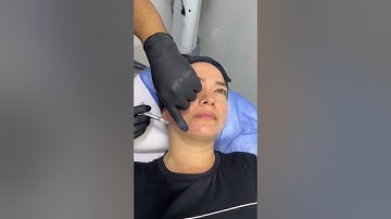 Bioestimulador de Colágeno Radiesse