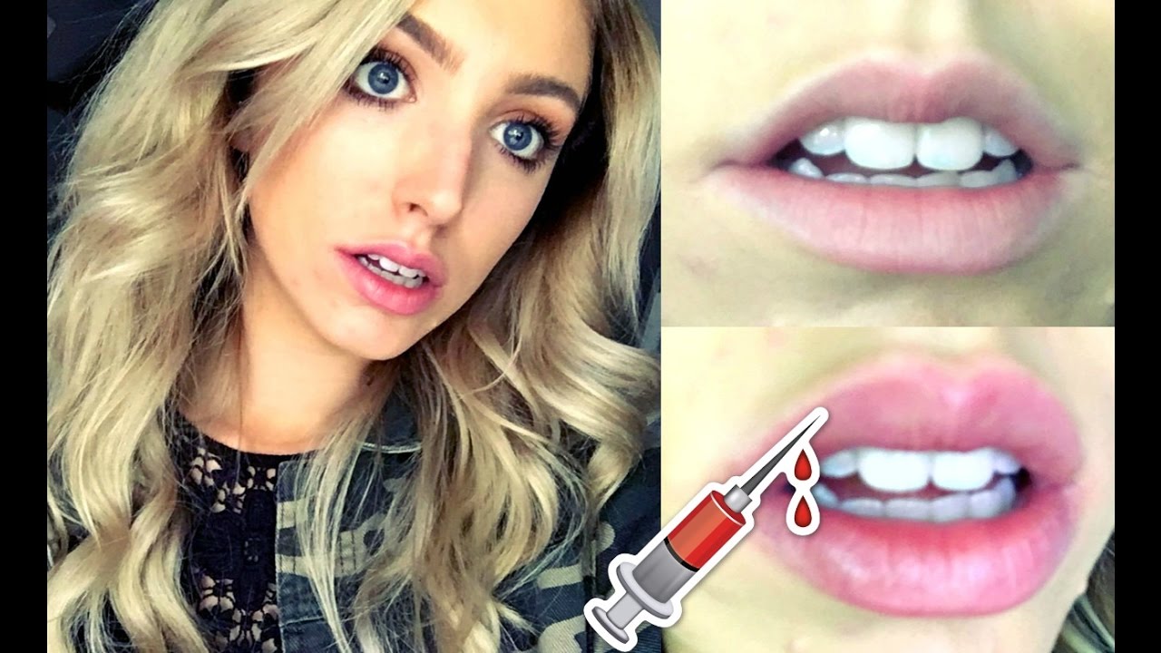 My Honest Experience Getting Lip Injections YouTube