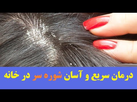 درمان سریع و آسان شوره سر در خانه