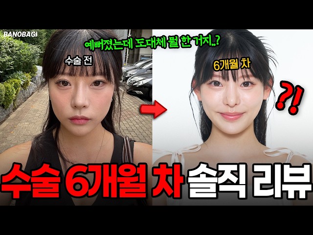 뭔가 예뻐졌는데 살 빠졌어?🔥 자연스러운 결과를 원하던 그녀의 솔직한 수술 리뷰💯 자가늑 코성형+쥬베룩볼륨(팔자,앞볼)+요정 귀필러 6개월 차 후기💛