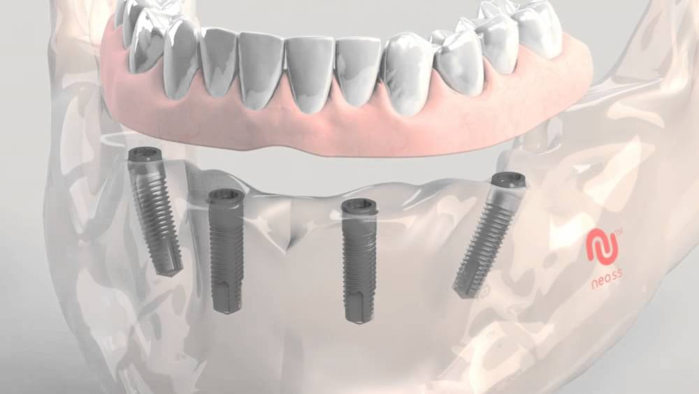 Neoss Implant- Fixed Hybridge