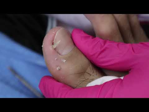 Ep_830 Foot skin removal 👣 เจ็บข้างเล็บอาจไม่ใช่เล็บขบนะ 😉  (This clip from Thailand)