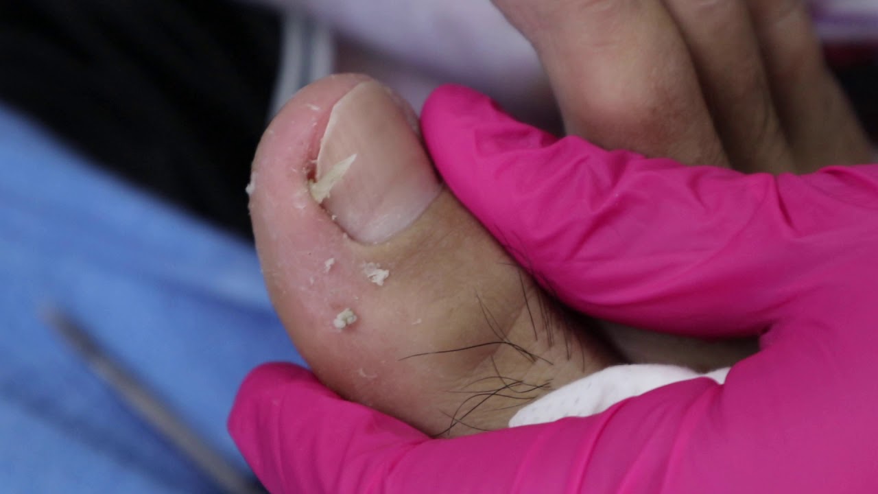 Ep_830 Foot skin removal ? เจ็บข้างเล็บอาจไม่ใช่เล็บขบนะ ?  (This clip from Thailand)