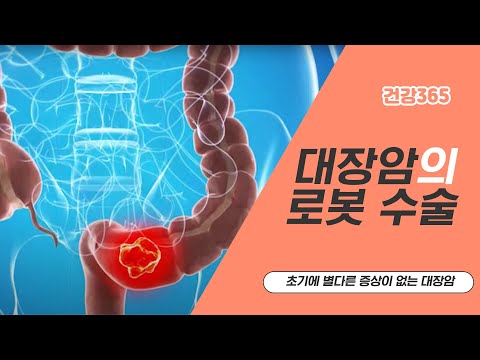 대장암의 로봇수술 [TBC클리닉건강365]