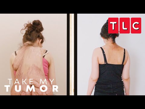 Alexandra Takes A Weight Off Her Back | Take My Tumor | TLC