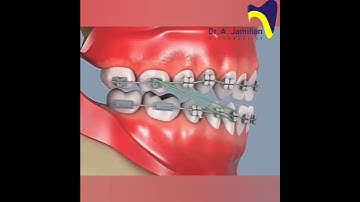 How to Use Orthodontic Elastics Rubber Bands for Braces to Fix Overbite, Underbite, and Crossbite