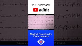 Anterolateral Stemi Ecg