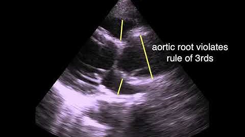 Acute Aortic Dissection, Stanford Type A, POCUS