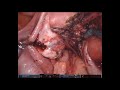 Stage 4 endometriosis in patient with infertility robotic da vinci andrea vidali md