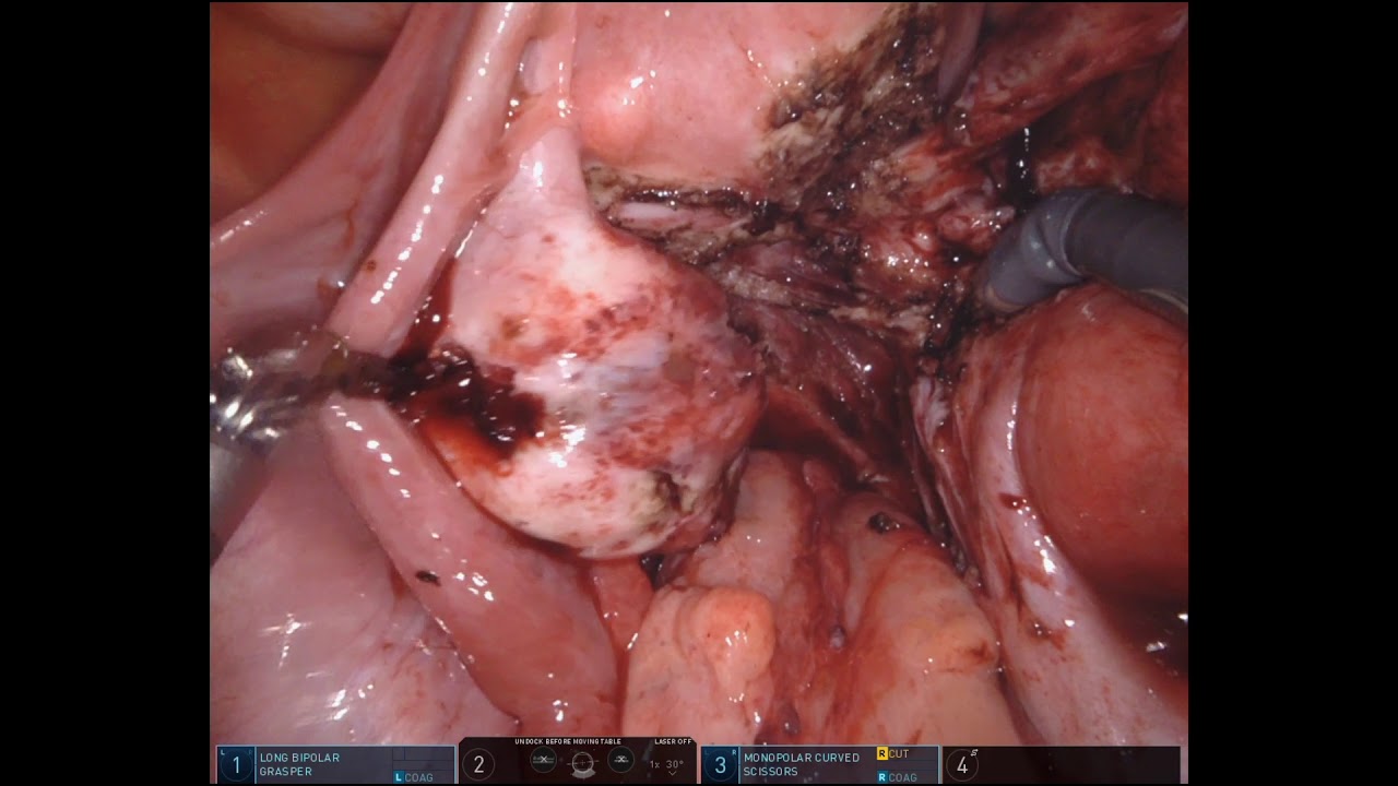 Stage 4 Endometriosis in patient with Infertility: Robotic Da Vinci
