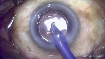 How to remove the Subincisional cortex trapped under the IOL