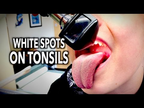 WHITE SPOTS ON TONSILS! | Dr. Paul