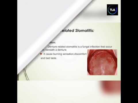 Stomatitis complete lecture