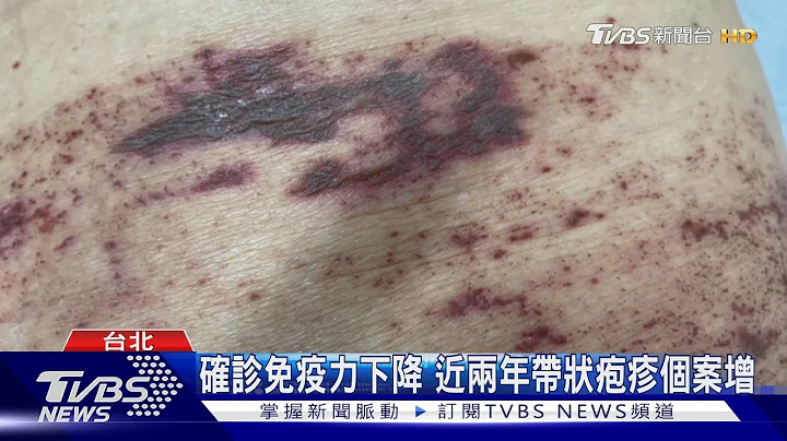 确诊免疫力下降 近两年带状疱疹个案增｜TVBS新闻@tvbsnews02 - 天天要闻