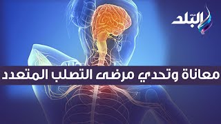 إحذر أعراض مرض الـ ms!.. معاناة وتحدى لمرضى التصلب المتعدد في مصر