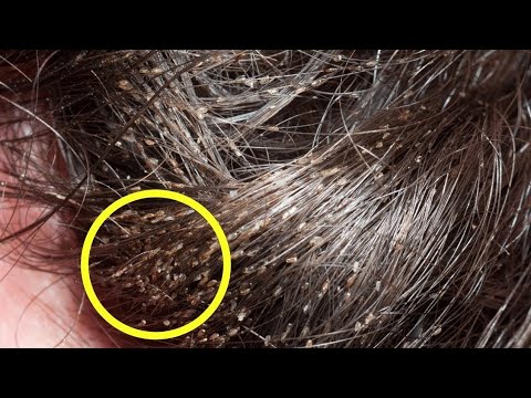 ఇలాచేస్తే  నిమిషాల్లో మీ తలలో పేలతో పాటు ఈపులు,పేలగుడ్లు కూడా మాయం..lice removing tips from hair