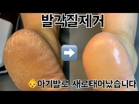 갈라지는 뒤꿈치 굳은살 발 각질 제거 드릴전문 관리 튜토리얼| Foot Callus  Removal