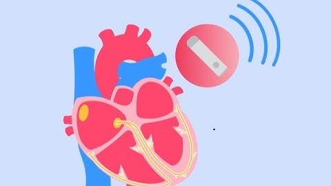 Understanding Implantable loop recorders