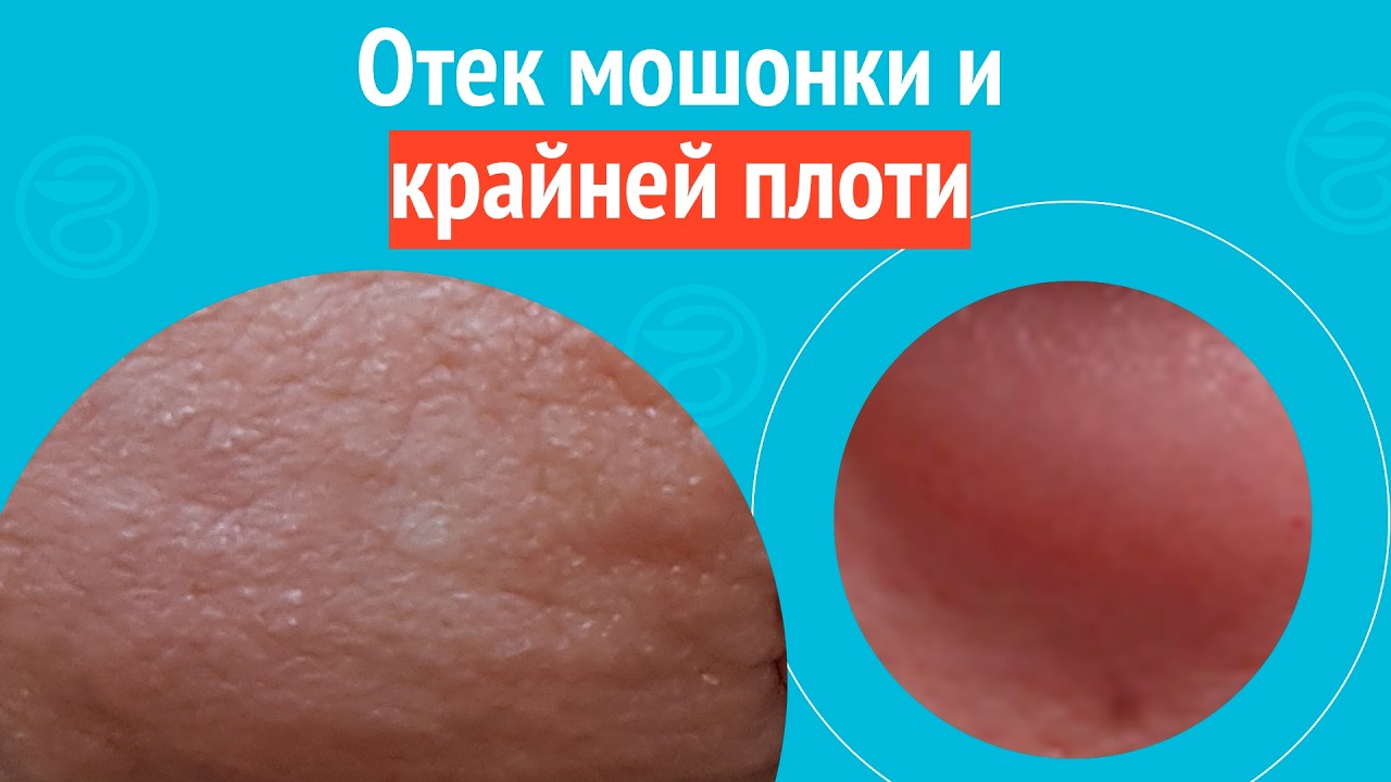 😯 Отек мошонки и крайней плоти. Клинический случай № 1739