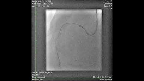 Complex PCI of Calcified RCA CTO
