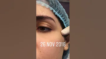 فيللر الصدغ من اهم المناطق التي تظهر جمال وإشراقه الوجه مع دكتور طارق حواش 