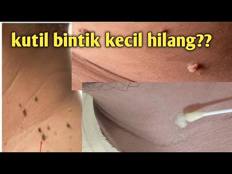 malu !!!! masih muda punya kutil?? cara ilangin kutil satu malam lepas