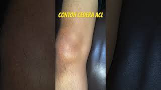Signs Of A Swollen Acl Injury injury mco massage therapy massage acl