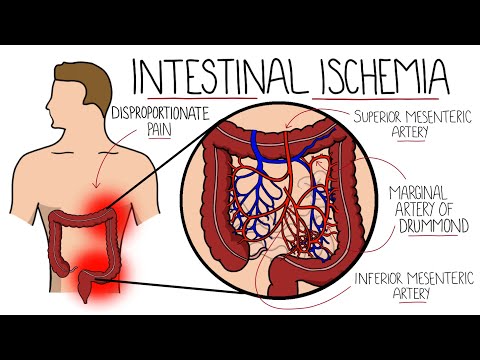 Intestinal Ischemia - Mesenteric Ischemia (Acute & Chronic) & Ischemic Colitis