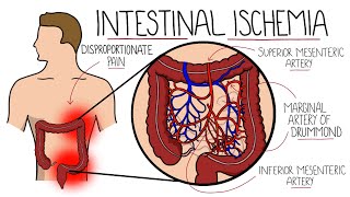 Intestinal Ischemia - Mesenteric Ischemia (Acute & Chronic) & Ischemic Colitis