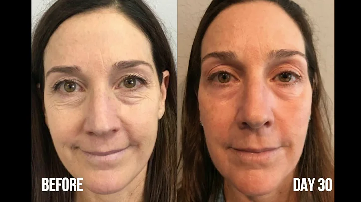 VLOG FOR Veronica Skin Resurfacing Treatment with ...