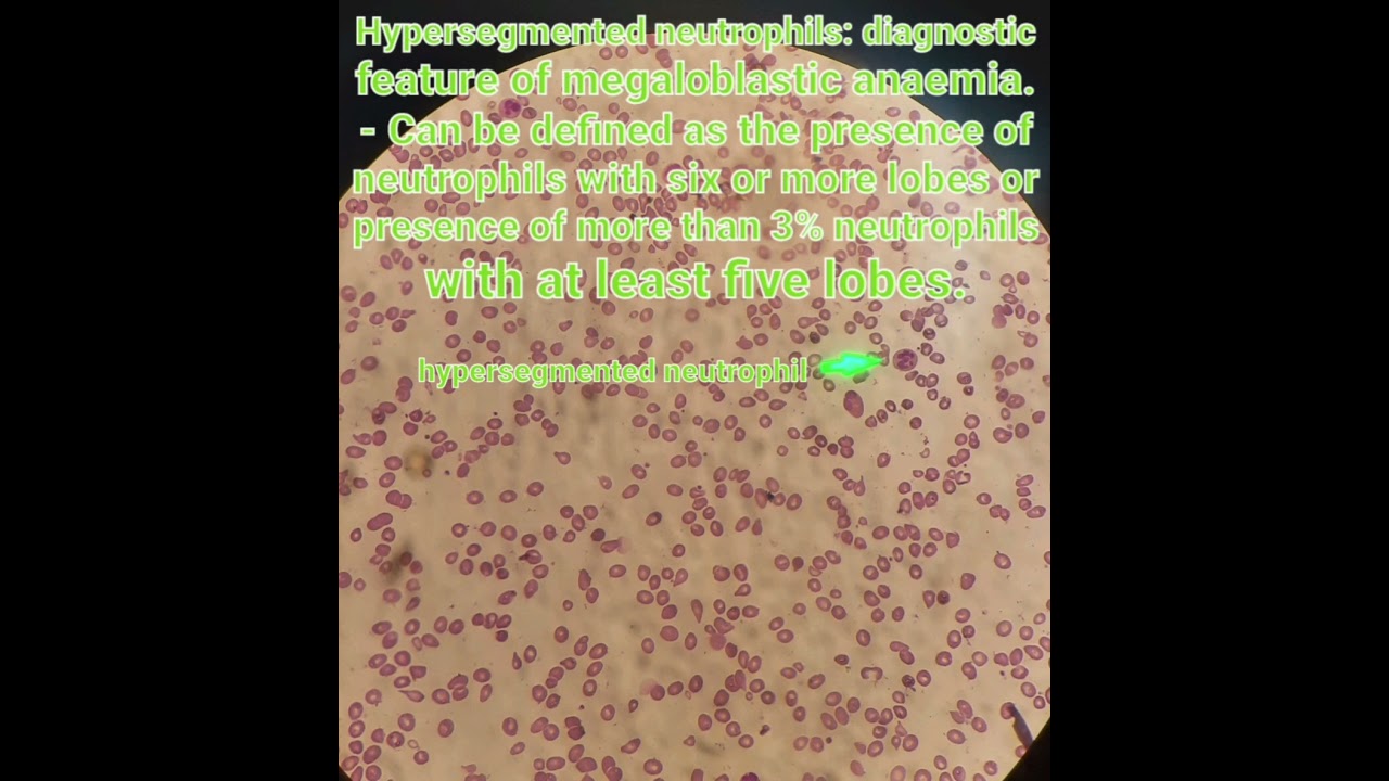 Hypersegmented neutrophil 