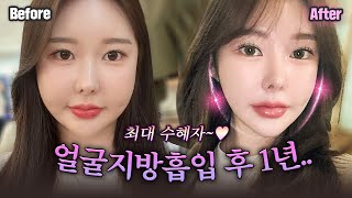 ❣️얼굴지방흡입 10개월 차｜30대 여성 2편｜안면윤곽+거상으로도 작아지지 않았던 얼굴!! 지방흡입으로는 얼마나 달라졌을지 경과 보러오세요-♥️