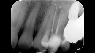 maxillary premolar enigma 4K