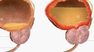 Understanding your prostate