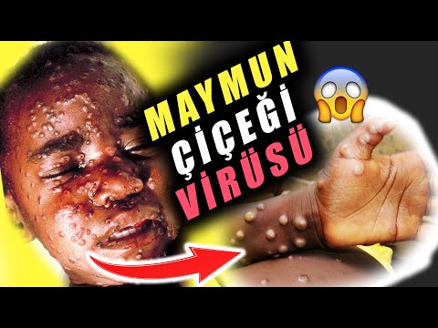 Dünyaya Yayılan MAYMUN ÇİÇEĞİ VİRÜSÜ Nedir❓Maymun Çiçeği Virüsü Hakkında Bilgi😱Maymun Çiçeği Türkiye